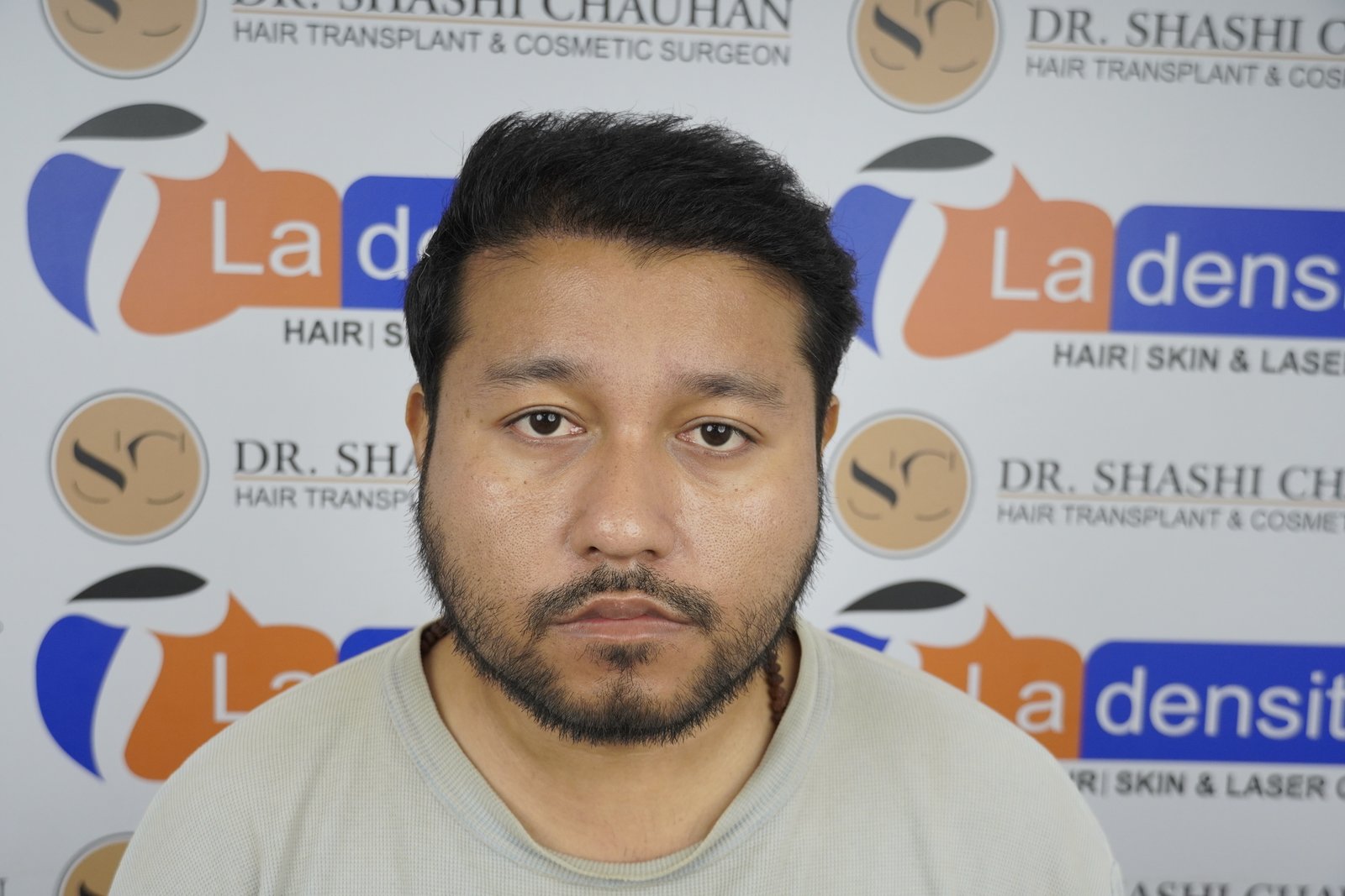 Dr. Bishal After Hair Transplant